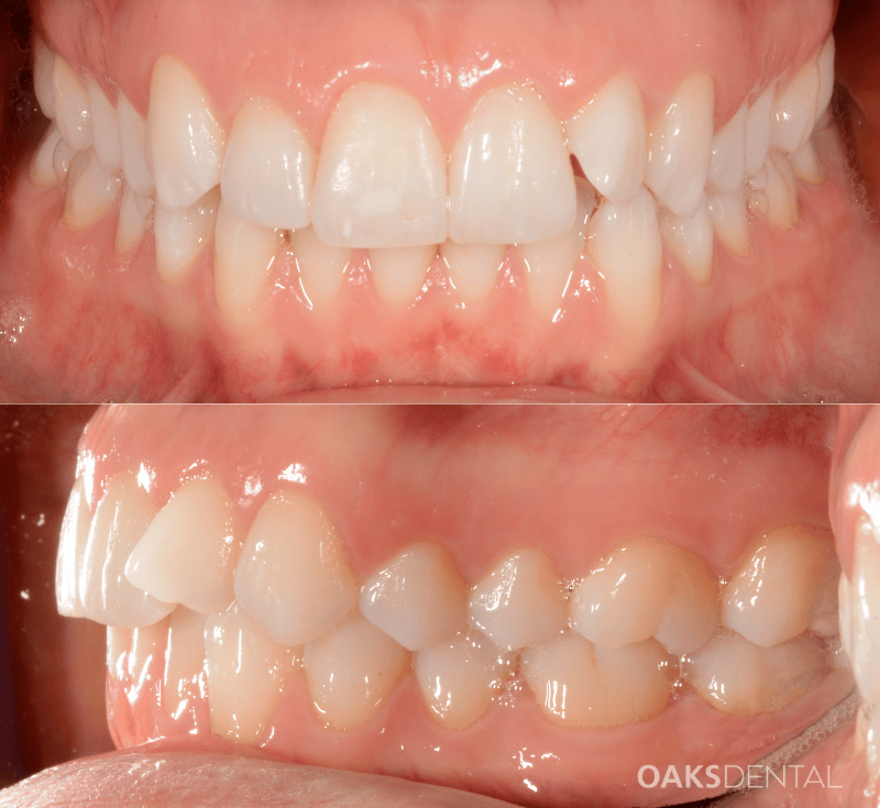Oaks Dental Neutral Bay Dentist-Orthodontic Dentistry-clear aligners-invisalign-Before and After