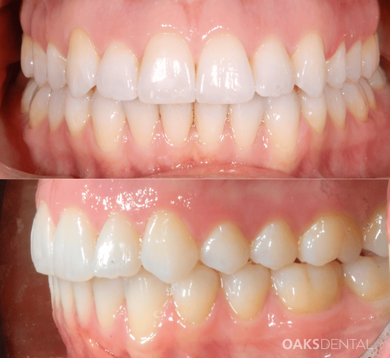 Oaks Dental Neutral Bay Dentist-Orthodontic Dentistry-clear aligners-invisalign-Before and After