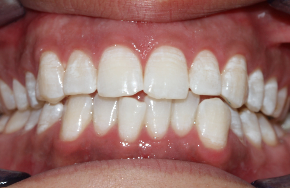 The Oaks Dental neutral bay-neutral bay-Teeth whitening-before and after