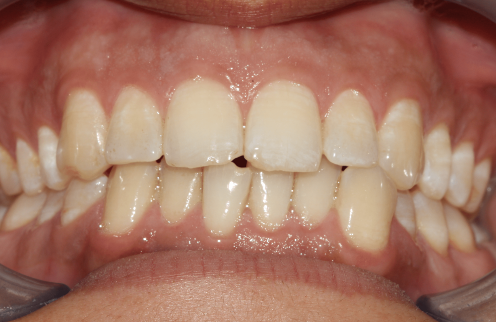 The Oaks Dental neutral bay-neutral bay-Teeth whitening-before and after