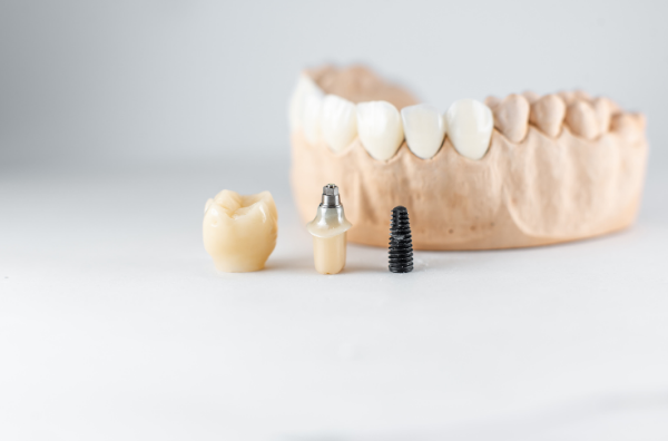 Oaks Dental neutral Bay-web-image Oaks Dental neutral Bay-web-image-dental implant<br />