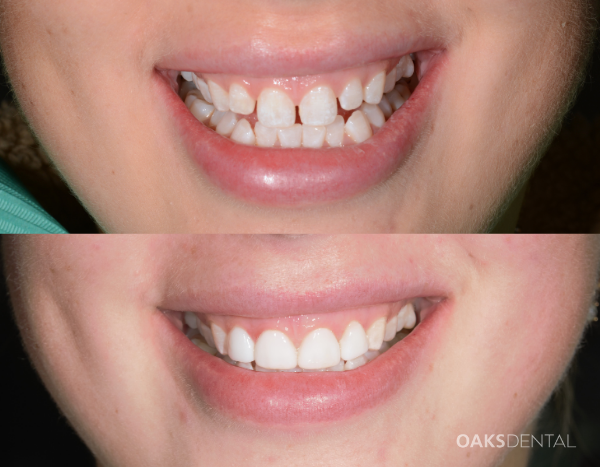 Oaks Dental Smile Design Oaks Dental Neutral Bay Smile Design