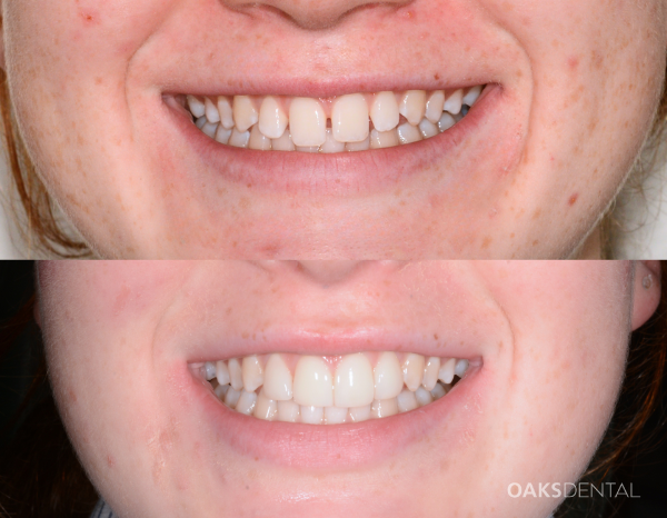 Oaks Dental Smile Design Oaks Dental Neutral Bay Smile Design