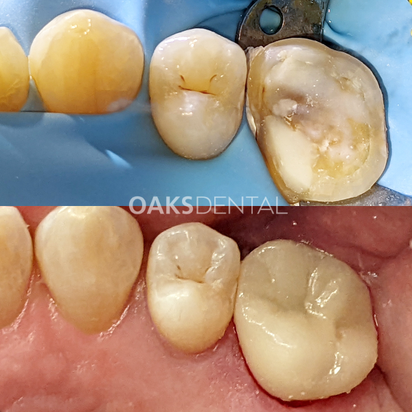 Oaks Dental Neutral Bay Dentist-Restorative Dentistry-Porcelain Onlay-Before and After Oaks Dental Neutral Bay Dentist-Restorative Dentistry-Porcelain Onlay-Before and After