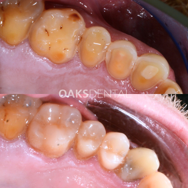 Oaks Dental Neutral Bay Dentist-Restorative Dentistry-Composite Crown-Before and After Oaks Dental Neutral Bay Dentist-Restorative Dentistry-Composite Crown-Before and After