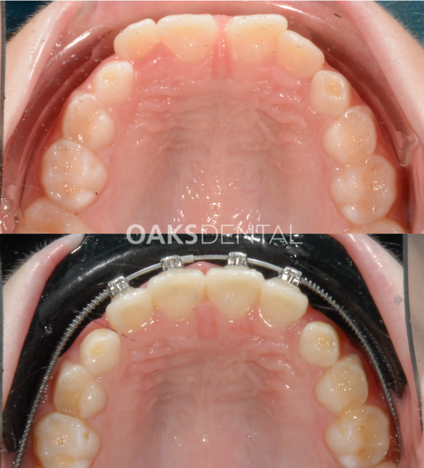 Oaks Dental Neutral Bay Dentist-Orthodontic Dentistry-Childrens dentistry-partial braces-Before and After