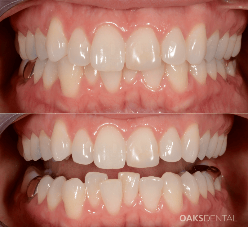 Oaks Dental Neutral Bay Dentist-Orthodontic Dentistry-clear aligners-invisalign-Before and After