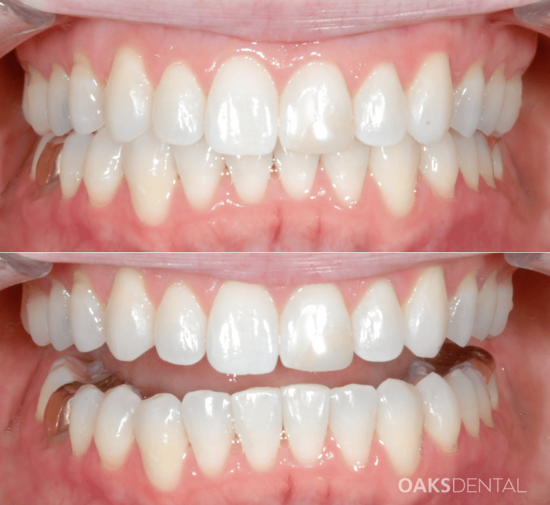 Oaks Dental Neutral Bay Dentist-Orthodontic Dentistry-clear aligners-invisalign-Before and After