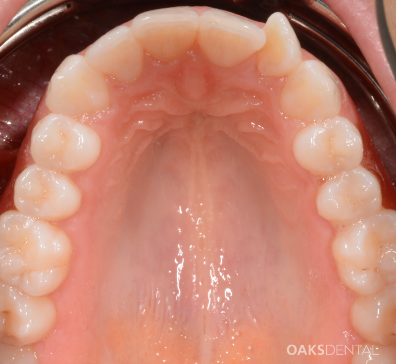 Oaks Dental Neutral Bay Dentist-Orthodontic Dentistry-clear aligners-invisalign-Before and After