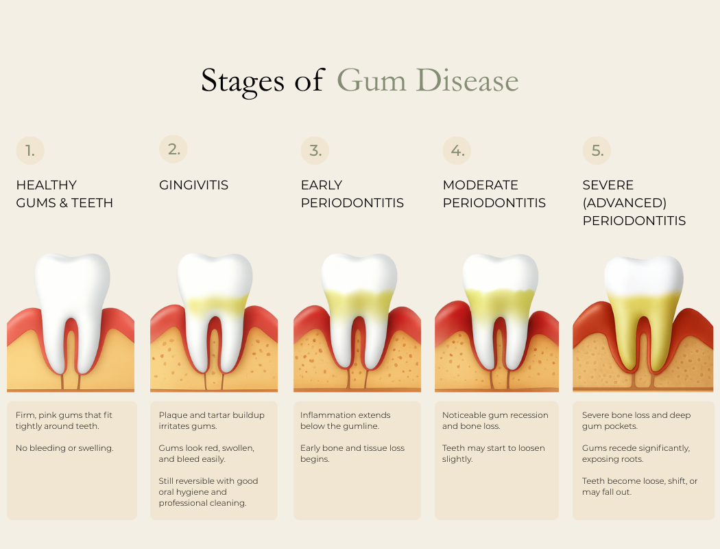 Oaks Dental Neutral Bay-Stages of Gum Disease Oaks Dental Neutral Bay-Stages of Gum Disease