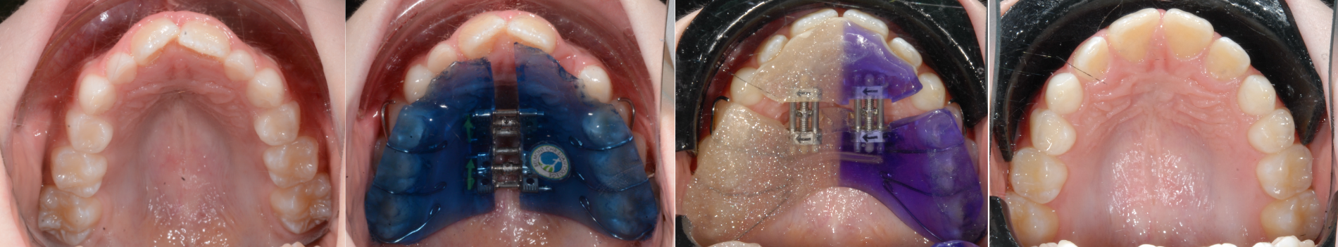 Early orthopaedic intervention Removable Upper Expanders