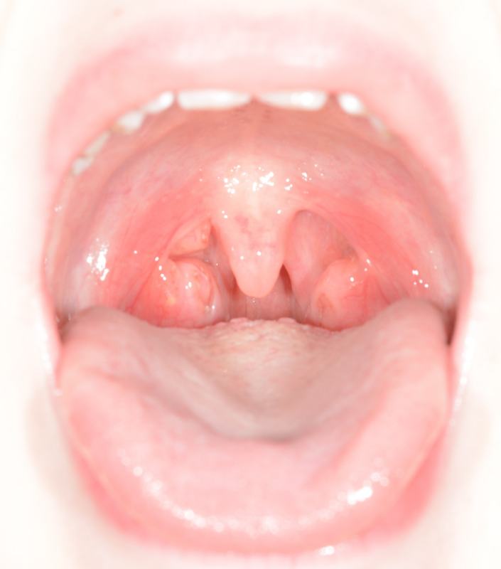 Enlarged Tonsils Oaks Dental Neutral Bay Dentist-Orthodontic Dentistry-Childrens Airway & Sleep-Enlarged tonsils