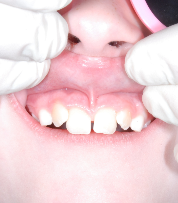 Lip Tie Oaks Dental Neutral Bay Dentist-Orthodontic Dentistry-Childrens Airway & Sleep-Lip Tie