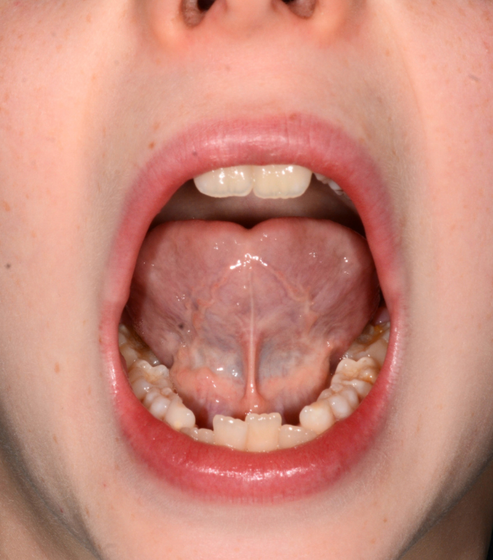 Tongue Tie Oaks Dental Neutral Bay Dentist-Orthodontic Dentistry-Childrens Airway & Sleep-Tongue Tie