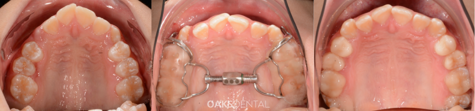Early orthopaedic intervention Fixed Upper Expander Oaks Dental-nuetral Bay Dentist-childrens dentistry-Early orthopaedic intervention<br />
Fixed Upper Expander