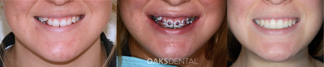 Oaks Dental Neutral Bay Dentist-Orthodontic Dentistry-Childrens dentistry-braces-Before and After