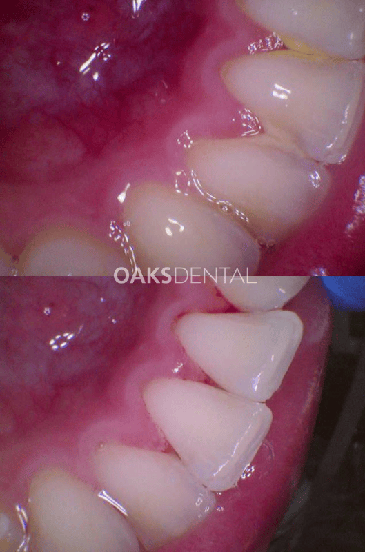 Website - Consented Before and After Finals (38) Oaks Dental Neutral Bay Dentist-gum disease calculus-Before and After