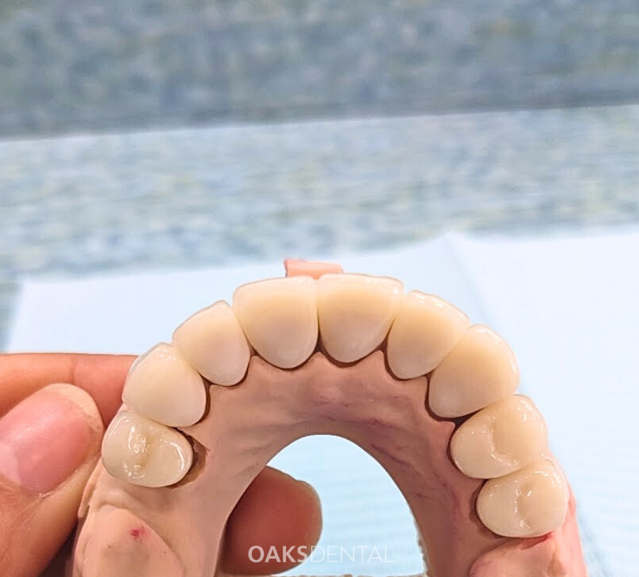 Website - Dental porcelain crown-2 Oaks Dental Neutral Bay Dental porcelain crown