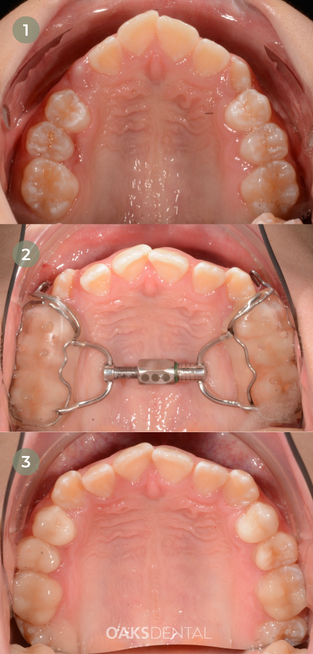Website - Fixed Upper Expander Oaks Dental Neutral Bay Dentist-Early orthopaedic intervention-Fixed Upper Expander-Childrens Dentistry