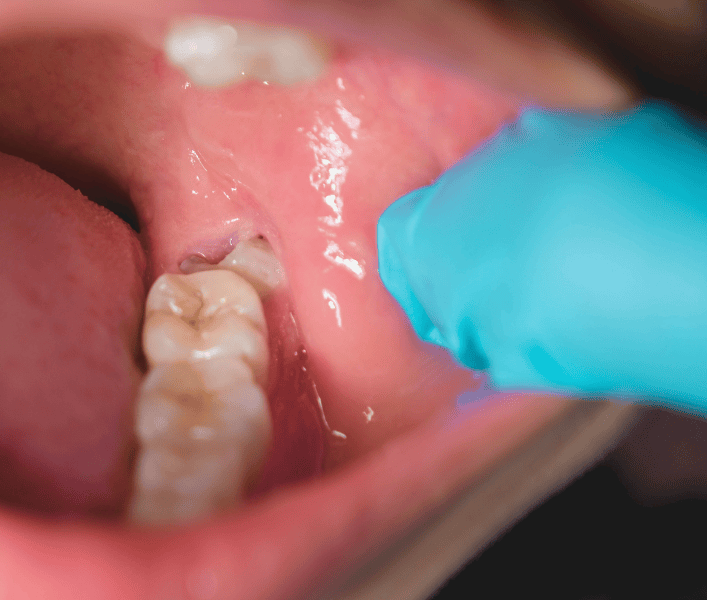 Website - Imagery (15) Oaks Dental Neutral Bay - Wisdom Tooth