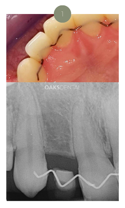 Website_dental implants_1 Website - Oaks Dental Neutral Bay-Dental implant_1a