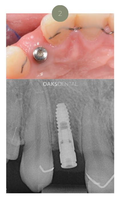 Website_dental implants_2 Website - Oaks Dental Neutral Bay-Dental implant_1a