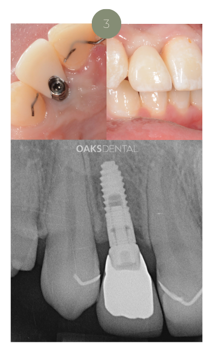 Website_dental implants_3
