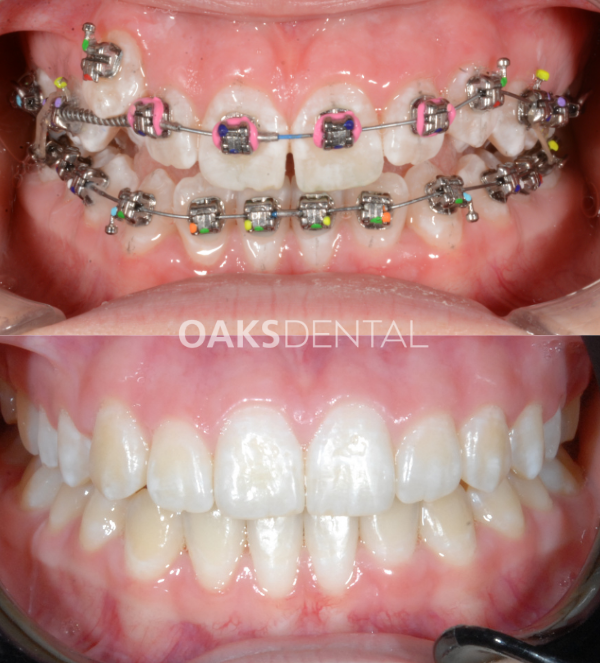 Oaks Dental Neutral Bay Dentist-Orthodontic Dentistry-Braces-Childrens dentistry-full braces-Before and After
