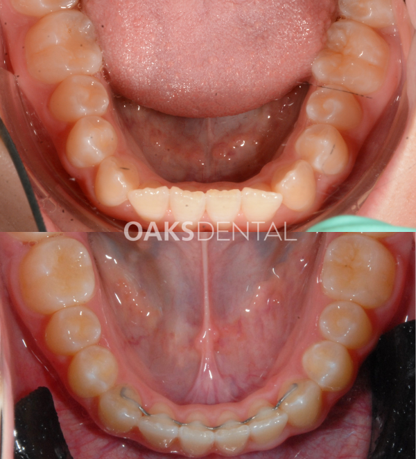 Oaks Dental Neutral Bay Dentist-Orthodontic Dentistry-Braces-Childrens dentistry-full braces-Before and After