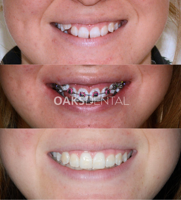 Oaks Dental Neutral Bay Dentist-Orthodontic Dentistry-Braces-Childrens dentistry-full braces-Before and After