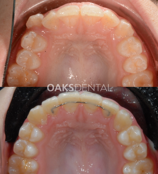 Oaks Dental Neutral Bay Dentist-Orthodontic Dentistry-Braces-Childrens dentistry-full braces-Before and After