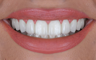 How Does Modern Smile Design Transform Your Smile From Digital Preview to Final Result? 