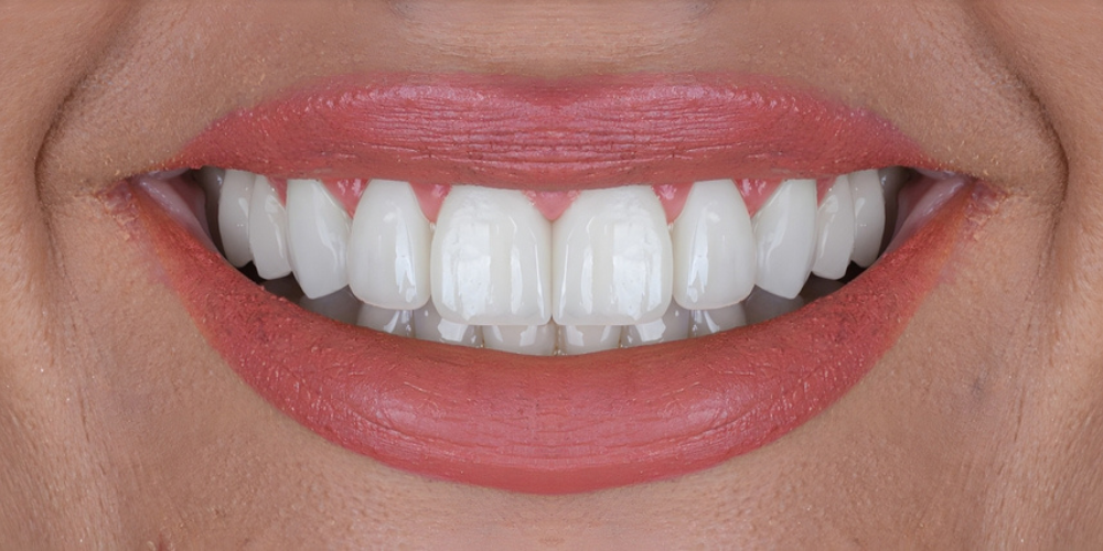 How Does Modern Smile Design Transform Your Smile From Digital Preview to Final Result How Does Modern Smile Design Transform Your Smile From Digital Preview to Final Result