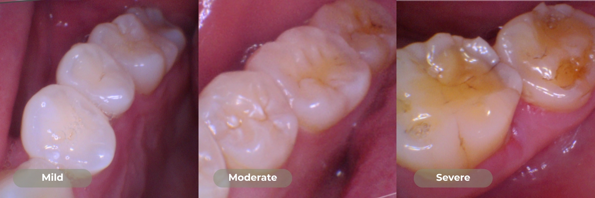 Visual signs of dental erosion, including translucent edges and cupped molar surfaces.