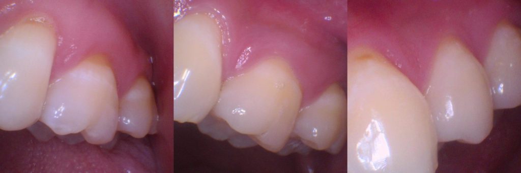 Close-up clinical photo showing mild toothbrush abrasion at the gumline, with subtle enamel thinning visible on the outer surfaces of the upper canine and premolar teeth. 
