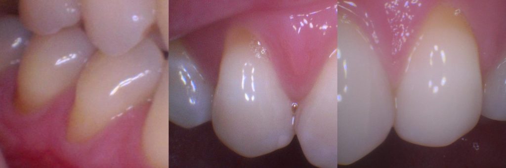 Close-up clinical photo of moderate toothbrush abrasion, showing visible wedge-shaped notches forming at the gumline of multiple teeth, with early dentine exposure.