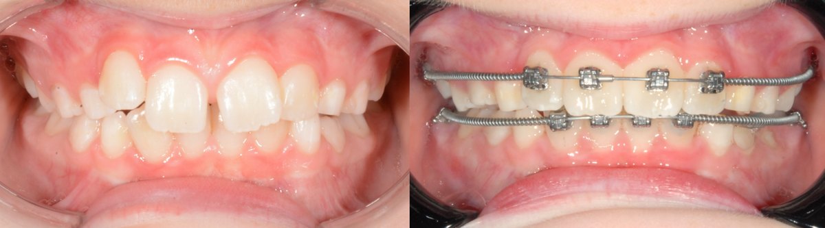 Partial braces fitted with open coil springs, used to regain space for a crowded tooth