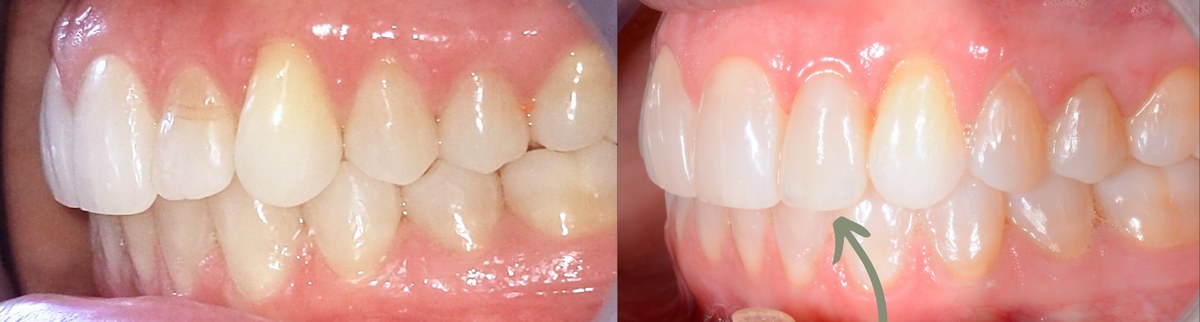 Side view of the upper teeth before and after treatment, with an arrow marking a discoloured tooth that has been restored with a porcelain veneer