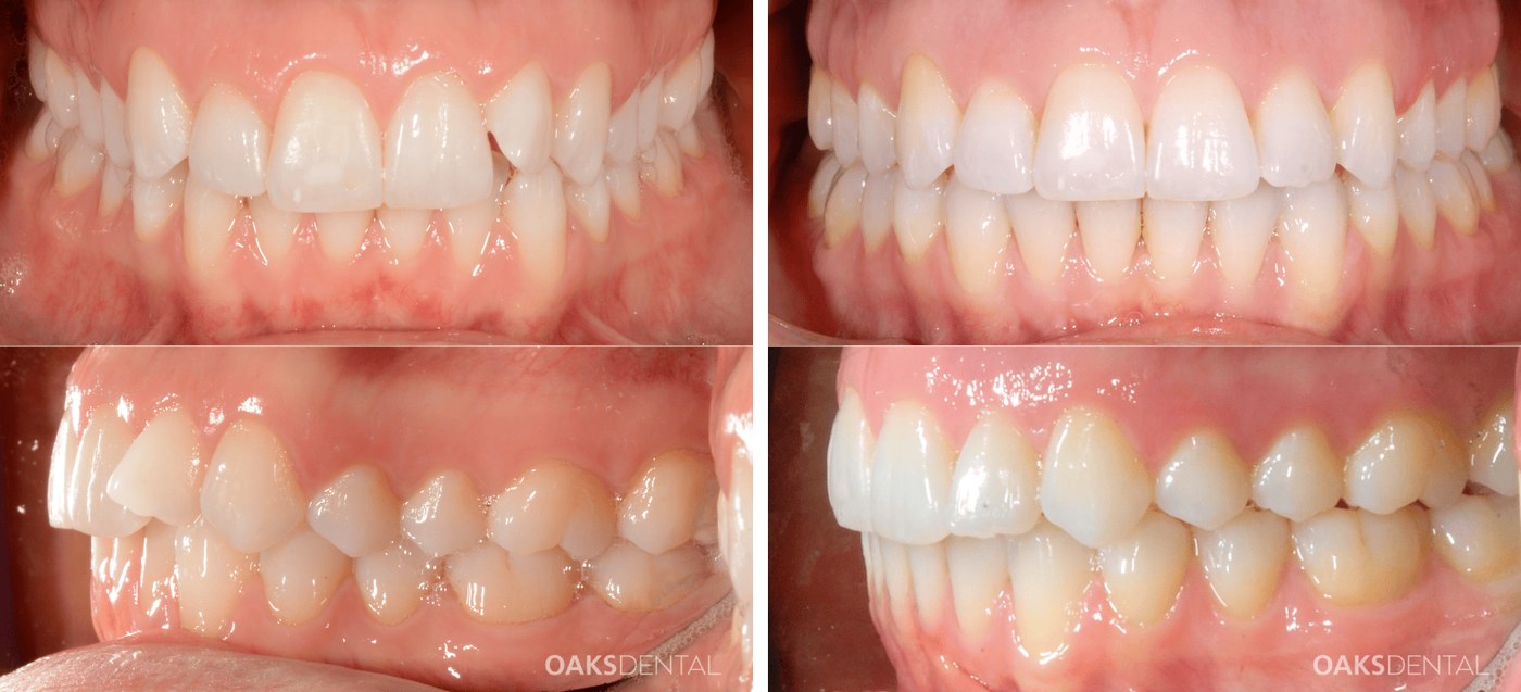 Crowded and rotated teeth seen from the front and side before clear aligner treatment, and the same teeth aligned afterwards