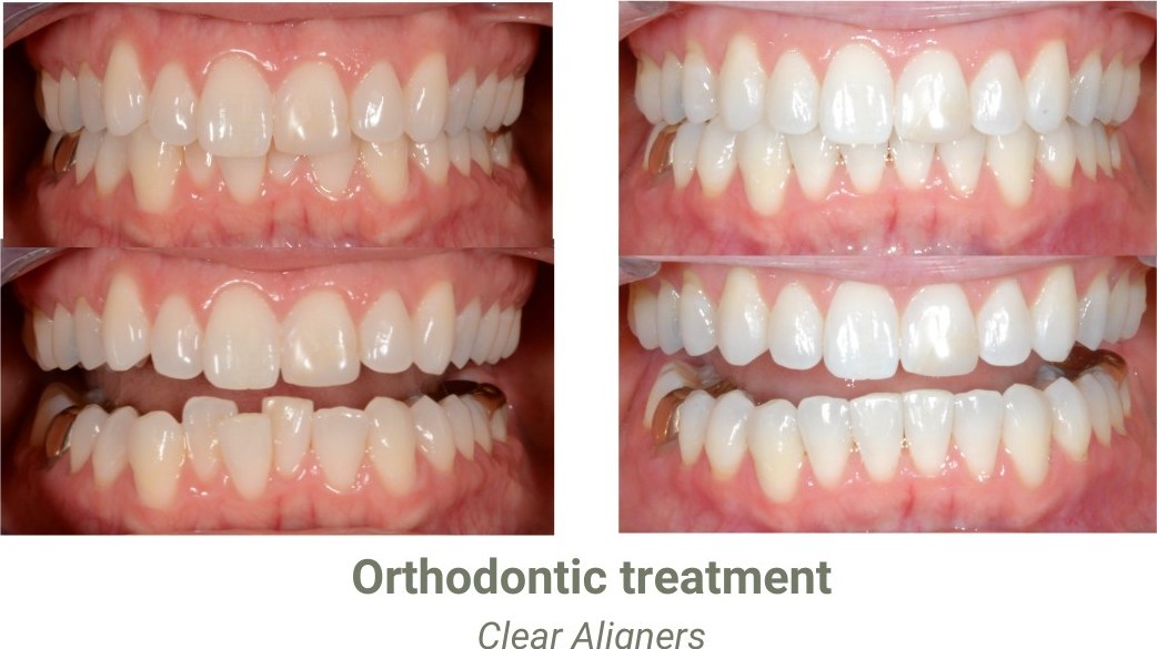Crowded and uneven front teeth before clear aligner treatment, and the same teeth aligned afterwards, seen biting together and slightly apart