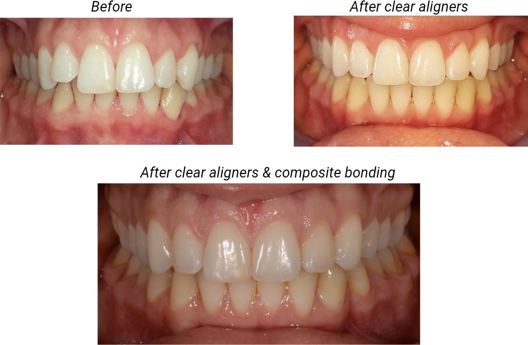 Front teeth before treatment, after clear aligner treatment, and after clear aligners followed by composite bonding