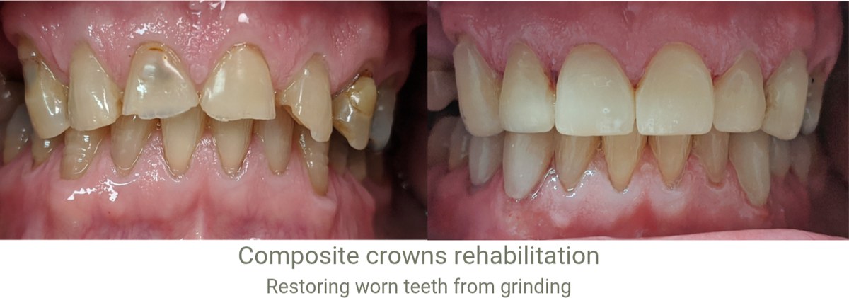 Teeth worn short by grinding before treatment, and the same teeth after being rebuilt with composite crowns