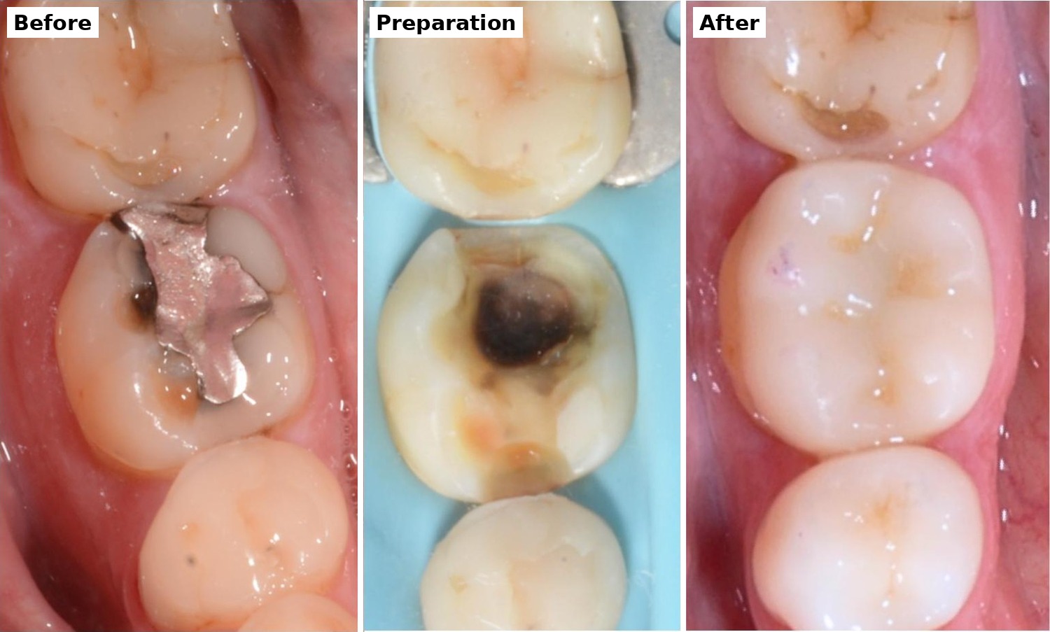 Before, preparation and after: a back tooth with an old amalgam filling and decay underneath, the weakened cusps reduced, then restored with a composite onlay
