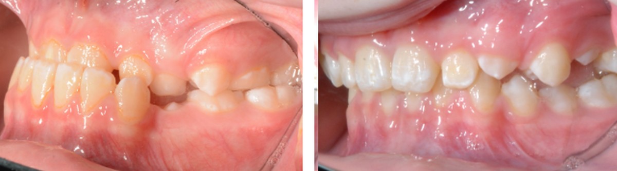Side view of an anterior crossbite before treatment, with the upper front teeth biting behind the lower ones, and the corrected bite afterwards
