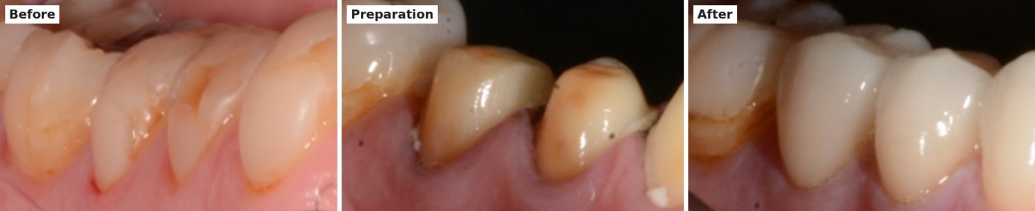 Before, preparation and after: broken-down lower back teeth trimmed and restored with crowns