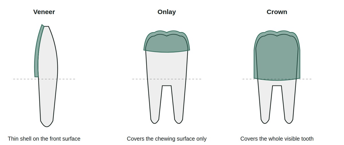 Diagram comparing a veneer, an onlay and a crown, showing how much of the tooth each one covers