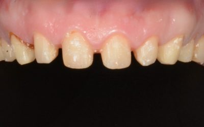 Do Crowns Weaken Teeth? The Truth About “Shaving Teeth Down”