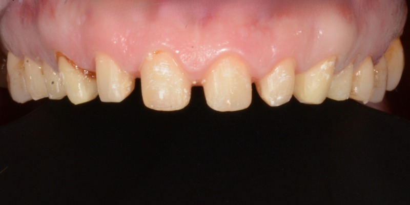 Do crowns weaken teeth header Upper front teeth trimmed and prepared for crowns