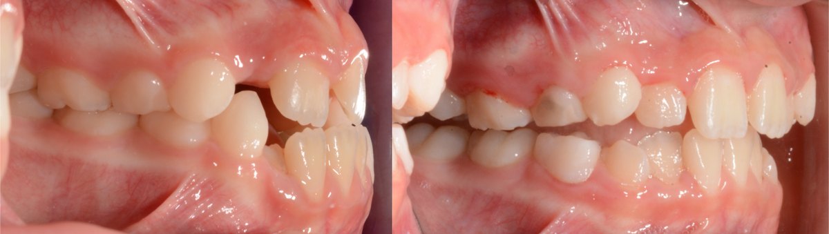 Side view of a child's bite before and after treatment with a fixed upper expander and protraction face mask