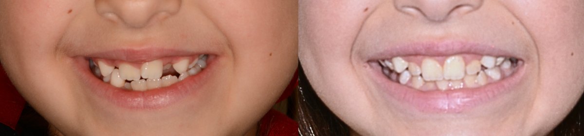 A child's smile before and after early orthopaedic treatment with a fixed upper expander and protraction face mask